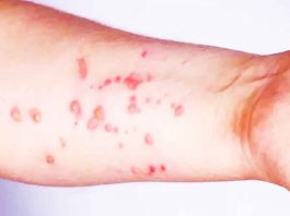 Secretaría de Salud emite estas recomendaciones sobre el mpox