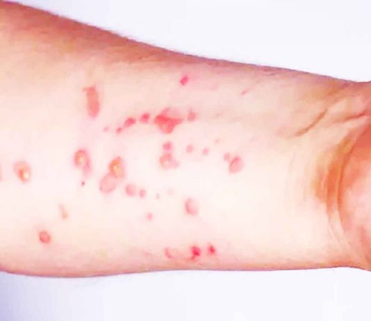 Secretaría de Salud emite estas recomendaciones sobre el mpox